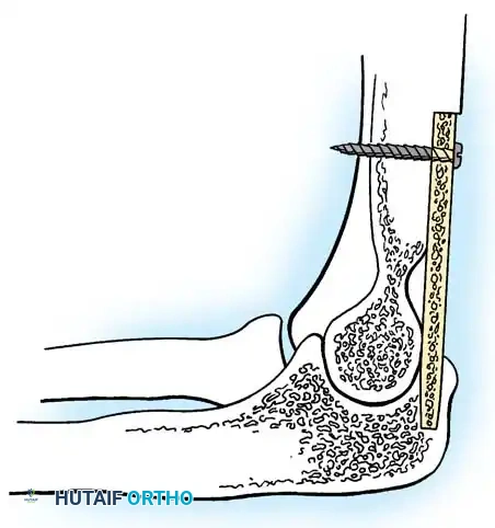 Illustration of elbow arthrodesis elbow - Dr. Mohammed Hutaif