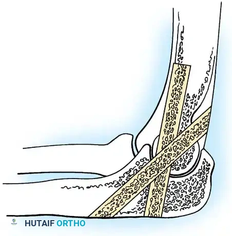 تقنية بريتين لدمج مفصل الكوع باستخدام طعوم عظمية متقاطعة