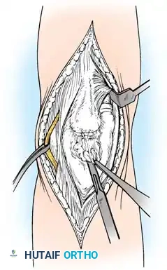 التحضير لتقنية أرافيلس لدمج الكوع لمرضى السل
