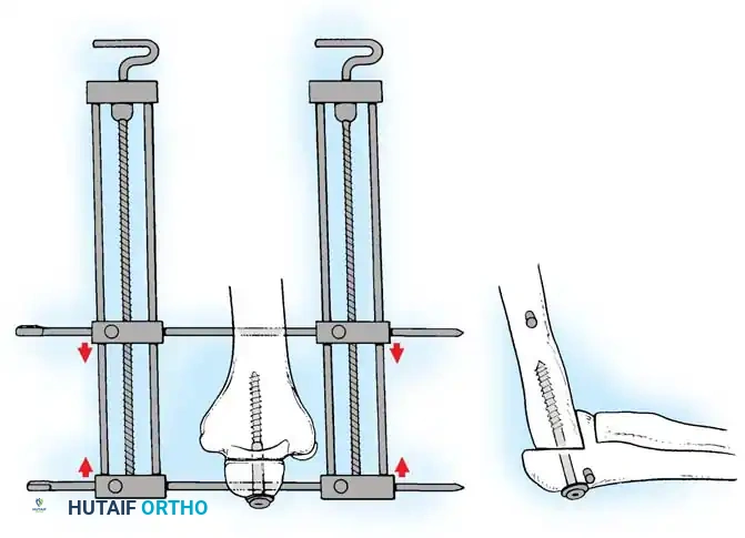 تقنية التثبيت الداخلي بشريحة معدنية لدمج الكوع