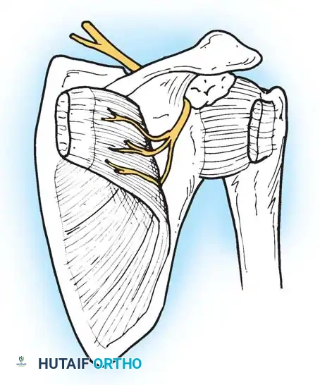 Fig. 44-19 Surgical approach for removal of ganglion. (Redrawn from Thompson RC, Schneider W, Kennedy T: Entrapment neuropathy of the inferior branch of the suprascapular nerve by ganglia, Clin Orthop Relat Res 166:185, 1982.)