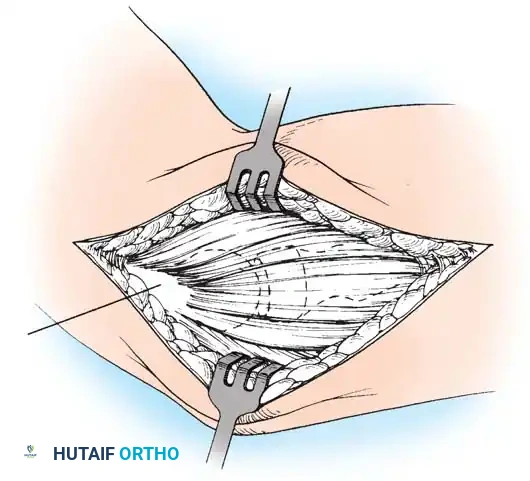 Operative Management of Lateral Epicondylitis: A Comprehensive Surgical Guide