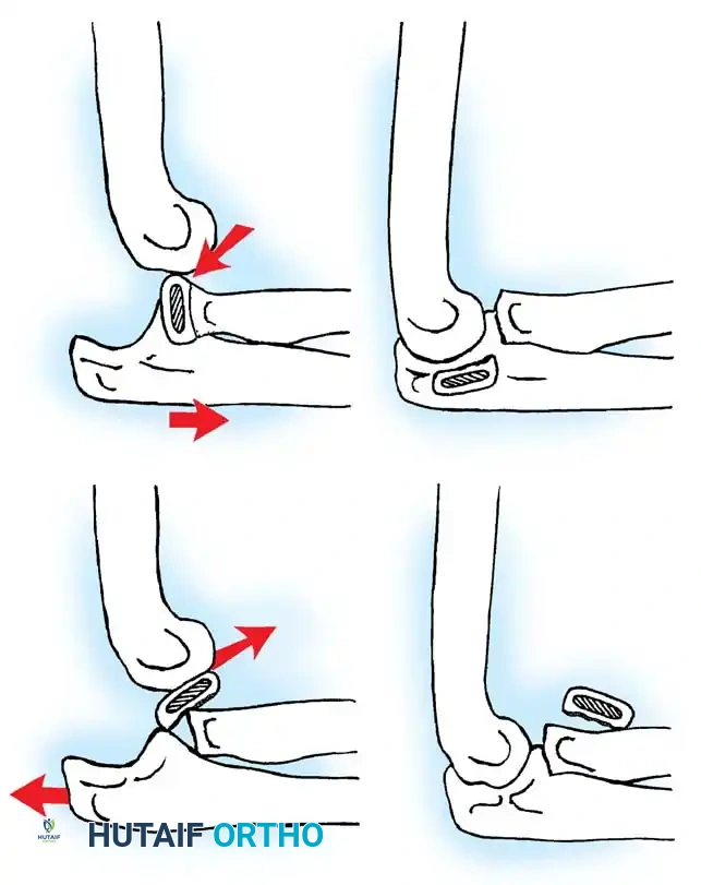 ELBOW JOINT FRACTURES AND DISLOCATIONS Surgical Diagram