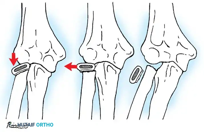ELBOW JOINT FRACTURES AND DISLOCATIONS Surgical Diagram