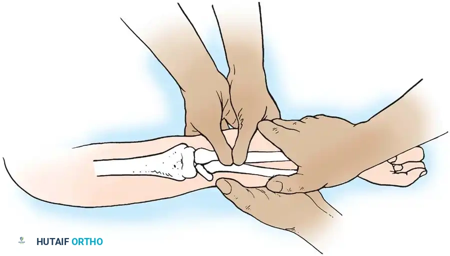 Fig. 33-42 Reduction technique for radial neck fractures.