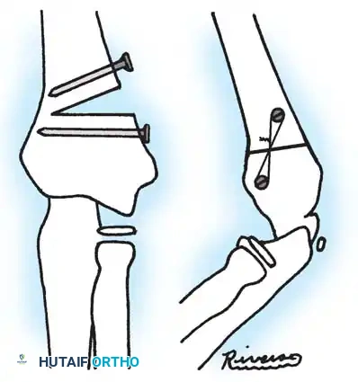 Hutaifortho's Orthopaedic Diagram