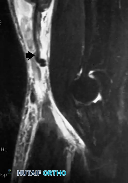 الدليل الشامل لتشخيص وعلاج إصابات الكوع والأورام العضلية الهيكلية