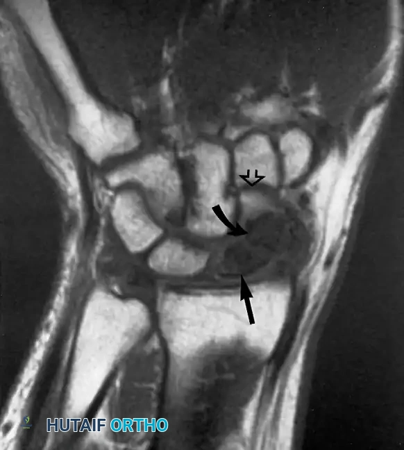 تنخر العظم الزورقي بعد التعرض لكسر في اليد