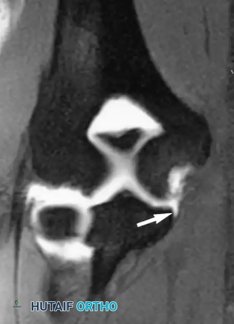 صورة رنين مغناطيسي مفصلي تظهر تمزق جزئي في الرباط الجانبي الزندي للكوع