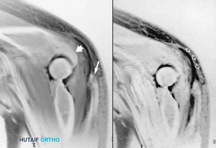 أشعة الرنين المغناطيسي تظهر انفصال وتر العضلة ثلاثية الرؤوس عن عظمة الناتئ الزجي