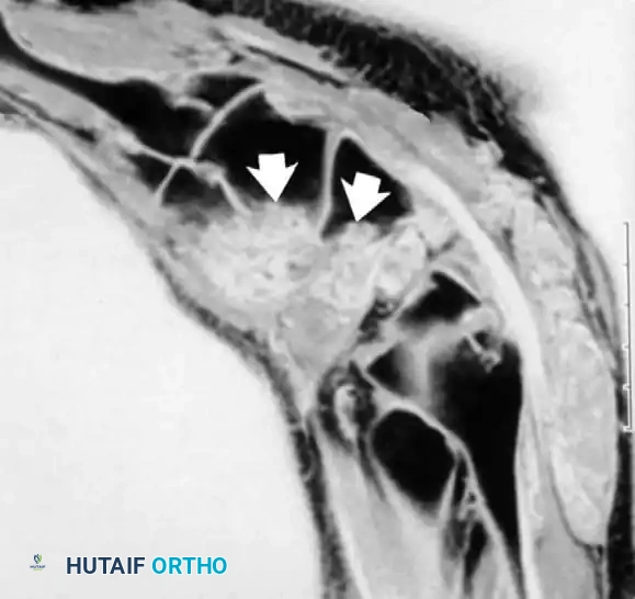 التهاب الغشاء المفصلي الزغابي العقدي المصبغ في القدم الجزء الثاني يوضح ترسب الهيموسيديرين