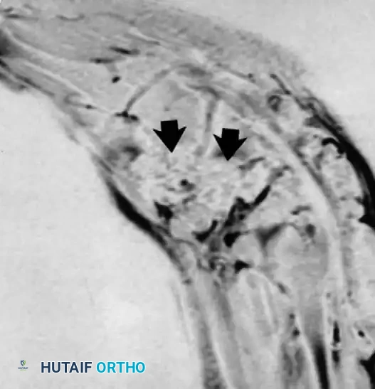 التهاب الغشاء المفصلي الزغابي العقدي المصبغ في القدم الجزء الأول