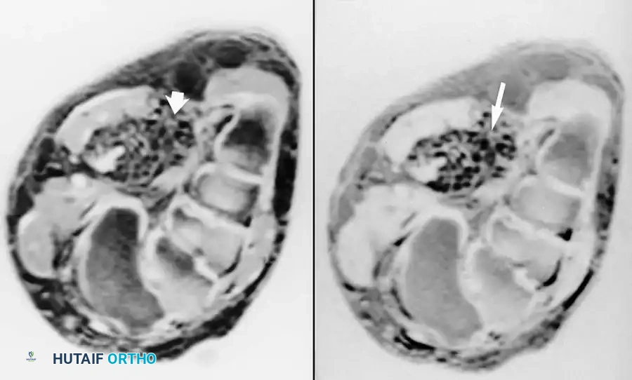 ورم وعائي دموي في الأنسجة الرخوة للقدم
