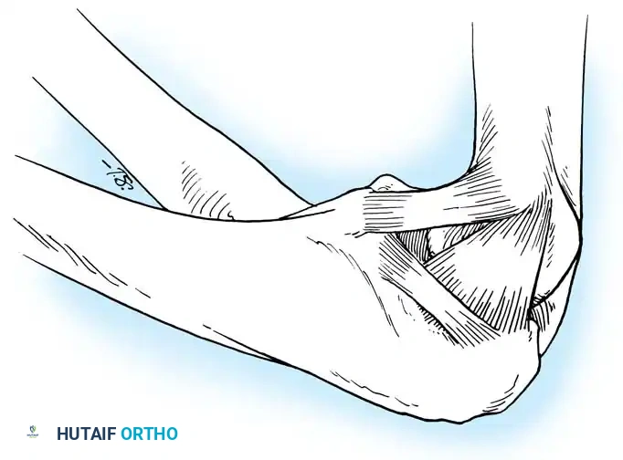 Fig. 45-62 Medial elbow ligaments. 1, anterior oblique; 2, posterior oblique; 3, transverse oblique. (From Tullos HS, Schwab G, Bennett JV, et al: Factors inﬂ uencing elbow instability, Instr Course Lect 30:185, 1981.)