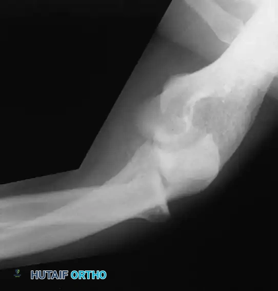 Fig. 45-63 Lateral stress radiograph showing posterolateral elbow instability.