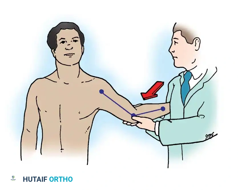 Fig. 45-64 Test for elbow instability. (Redrawn from Conway JE, Jobe FW, Glousman RE, et al: Medial instability of the elbow in throwing athletes, J Bone Joint Surg 74A:67, 1992.)