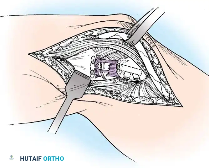 Advanced imaging and stress radiography demonstrating joint space widening.