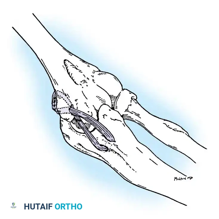 Medial curvilinear incision and initial exposure of the medial epicondyle.