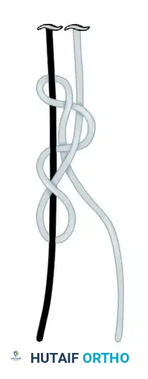 ELBOW Surgical Diagram