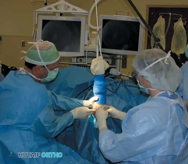 Fig. 49-58 Operating room setup for patient in supine position with elbow maintained at 90 degrees of ﬂ exion and 90 degrees of shoulder abduction by overhead traction through sterile stockinette. Surgeon with sterile drape around waist and sitting comfortably with television screen placed directly across table.