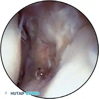 Establishing the portal with a blunt trocar