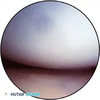 Anterolateral portal trajectory