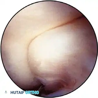 Masterclass in Elbow Arthroscopy: Principles and Techniques