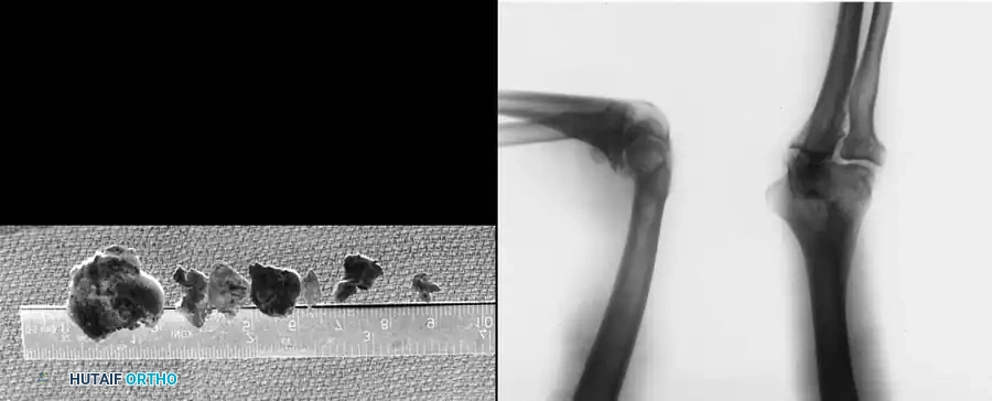 Intra-articular view of medial compartment