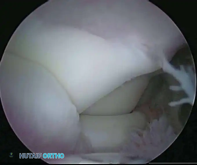 Proximal medial portal establishment