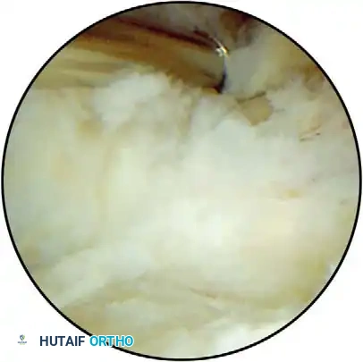 Arthroscopic view from anterolateral portal