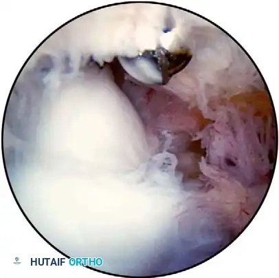 Arthroscopic view of loose body