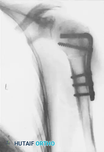 ELBOW Surgical Diagram