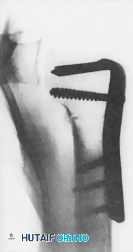 ELBOW Surgical Diagram