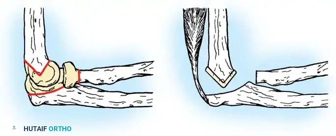 Fig. 8-32 Functional arthroplasty.