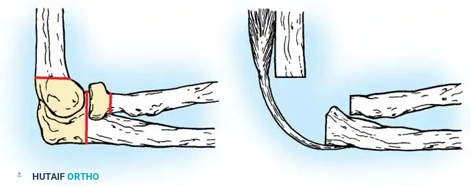 Fig. 8-31 Resection arthroplasty.