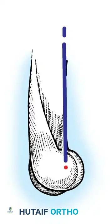 Fig. 8-34 Axis of rotation of elbow in ﬂ exion and extension is through center of trochlea, colinear with distal anterior cortex of humerus.