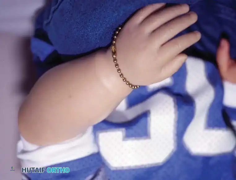 Fig. 76-3 A and B, Early ﬁ tting of passive prosthesis in child with congenital forearm amputation may encourage use of prosthesis.