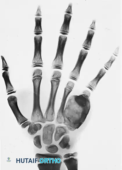 ENCHONDROMA Surgical Diagram