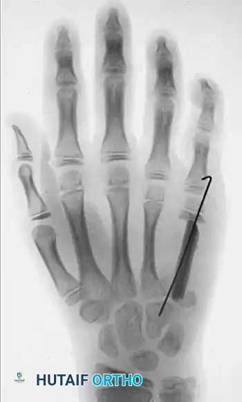 ENCHONDROMA Surgical Diagram