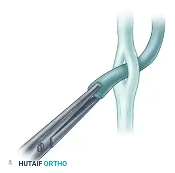 Masterclass in Operative Orthopaedics: End-to-Side Tendon Repair and Tendon-to-Bone Attachment