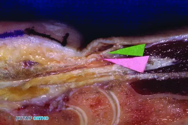 Close-up of Subligamentous Anatomy