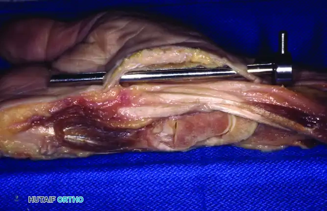 Cadaveric View of Cannula Placement