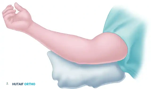 Cross-Sectional View of Fascial Division