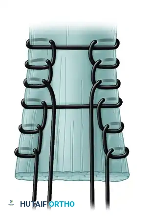ENDOSCOPIC QUADRUPLE HAMSTRING GRAFT Surgical Diagram