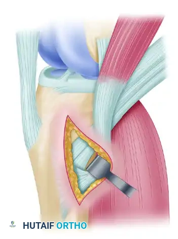 ENDOSCOPIC QUADRUPLE HAMSTRING GRAFT Surgical Diagram