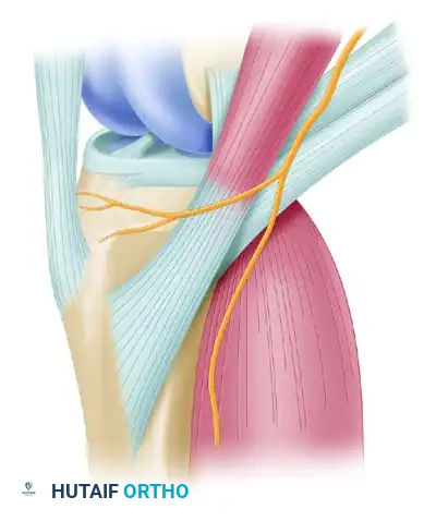 ENDOSCOPIC QUADRUPLE HAMSTRING GRAFT Surgical Diagram