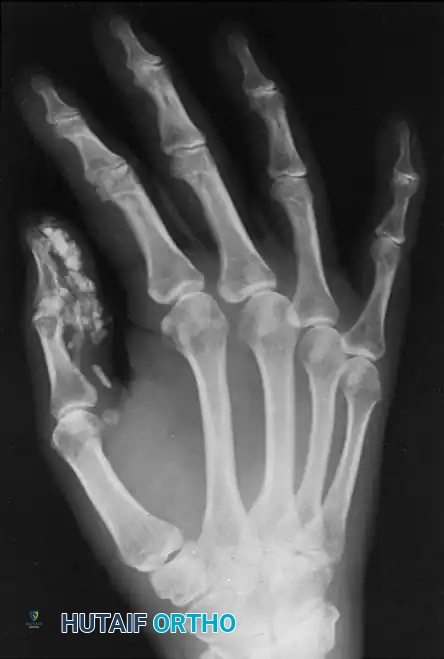 Orthopaedic Management of Epidermolysis Bullosa and Associated Hand Lesions