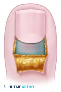 الدليل الشامل حول عملية توخيف طية الظفر لعلاج الداحس المزمن