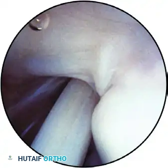 ESTABLISHING THE SUPERIOR PORTAL Surgical Diagram