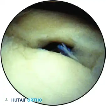 ESTABLISHING THE SUPERIOR PORTAL Surgical Diagram